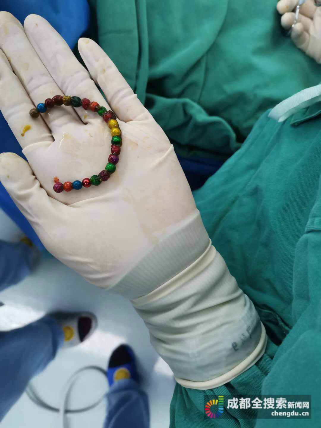 手术成功，22颗珠子全部取出。
