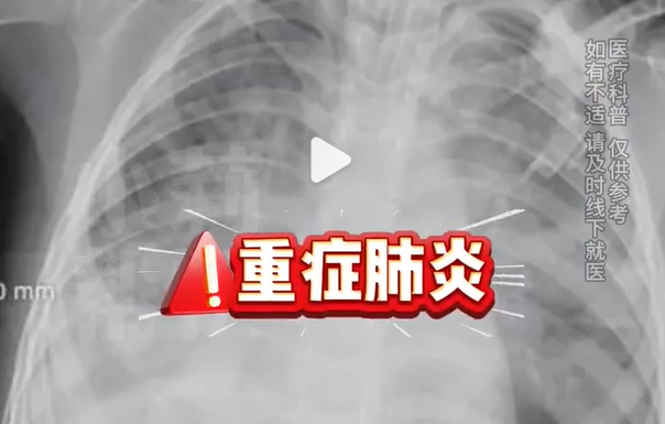 4岁女童甲流合并细菌感染肺都白了