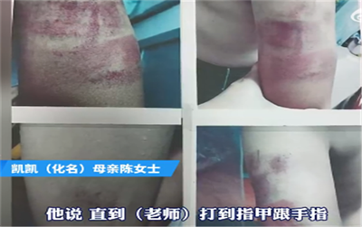 小学老师打伤学生仅取消评优资格引争议