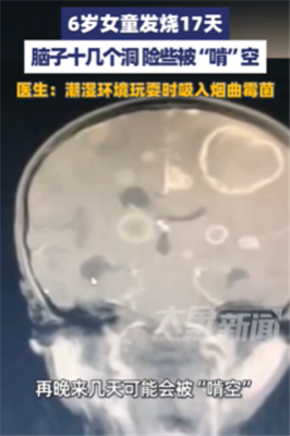 6岁女童发烧17天，脑子被“啃”十几个洞